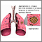 Aspergilloma Aspergilloma