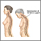 Osteoporosis Osteoporosis