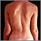 Scoliosis Scoliosis