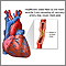 Angina