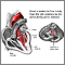 Aortic stenosis Aortic stenosis