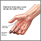 Thromboangiitis obliterans