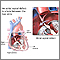 Atrial septal defect Atrial septal defect