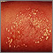 Pustules - superficial on the arm Pustules - superficial on the arm