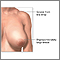 Breast reduction (mammoplasty) - series - Indications Breast reduction (mammoplasty) - series - Indications