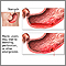 Ulcer emergencies