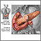 Cause of peptic ulcers Cause of peptic ulcers