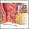 Anorectal fistulas Anorectal fistulas