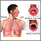 Asthmatic bronchiole and normal bronchiole