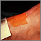 Sweat test Sweat test