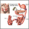 Biliopancreatic diversion (BPD) Biliopancreatic diversion (BPD)