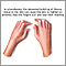 Sclerodactyly Sclerodactyly