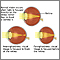 Normal, nearsightedness, and farsightedness Normal, nearsightedness, and farsightedness