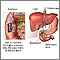 ERCP
