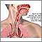 Airway burn Airway burn