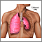Collapsed lung, pneumothorax Collapsed lung, pneumothorax