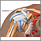 Impingement syndrome Impingement syndrome