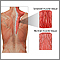 Muscle strain Muscle strain