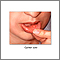 Canker sore Canker sore