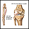 Knee misaligned due to arthritis Knee misaligned due to arthritis