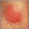 Granuloma annulare - close-up Granuloma annulare - close-up