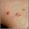 Chigger bite - close-up of blisters Chigger bite - close-up of blisters