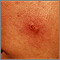 Leishmaniasis, mexicana - lesion on the cheek Leishmaniasis, mexicana - lesion on the cheek