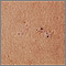 Blackheads (comedones) Blackheads (comedones)
