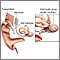 Cochlear implant Cochlear implant