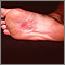 Dermatitis, nickel on the sole Dermatitis, nickel on the sole