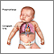 Pneumothorax Pneumothorax