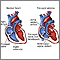 Tricuspid atresia Tricuspid atresia