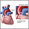 Aortopulmonary window Aortopulmonary window