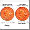 Diabetic retinopathy Diabetic retinopathy