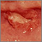 Canker sore (aphthous ulcer) Canker sore (aphthous ulcer)
