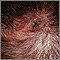 Ringworm, tinea capitis - close-up Ringworm, tinea capitis - close-up