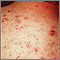 Acne - vulgaris on the back