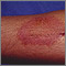 Dermatitis - contact Dermatitis - contact