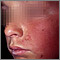 Dermatitis - contact on the cheek Dermatitis - contact on the cheek