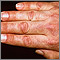 Dermatomyositis - Gottron papule Dermatomyositis - Gottron papule