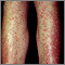 Drug rash - Tegretol Drug rash - Tegretol