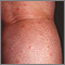 Insect bites on the legs Insect bites on the legs