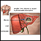 Amebic liver abscess Amebic liver abscess