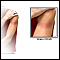 Arm Rash After COVID-19 Vaccination Arm Rash After COVID-19 Vaccination