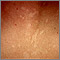 Tinea versicolor - close-up Tinea versicolor - close-up