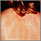Tinea versicolor on the back Tinea versicolor on the back