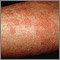 Hives (urticaria) on the arm Hives (urticaria) on the arm