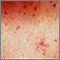 Urticaria pigmentosa - close-up