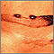 Keloid - pigmented Keloid - pigmented