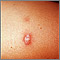 Sarcoidosis - close-up Sarcoidosis - close-up